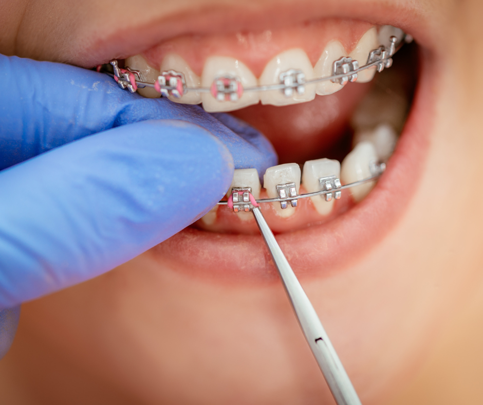 Orthodontic Blog